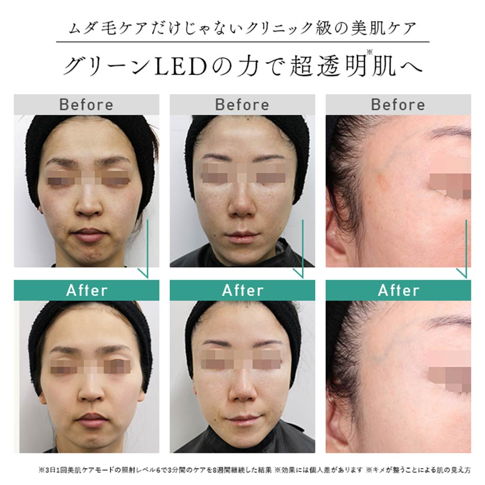 STELLA BEAUTE IPL&amp;LED光美容器 SB-IFD03 / STELLA BEAUTE（ステラ ボーテ） / その他美容家電 / STB10001_dt_06.jpg