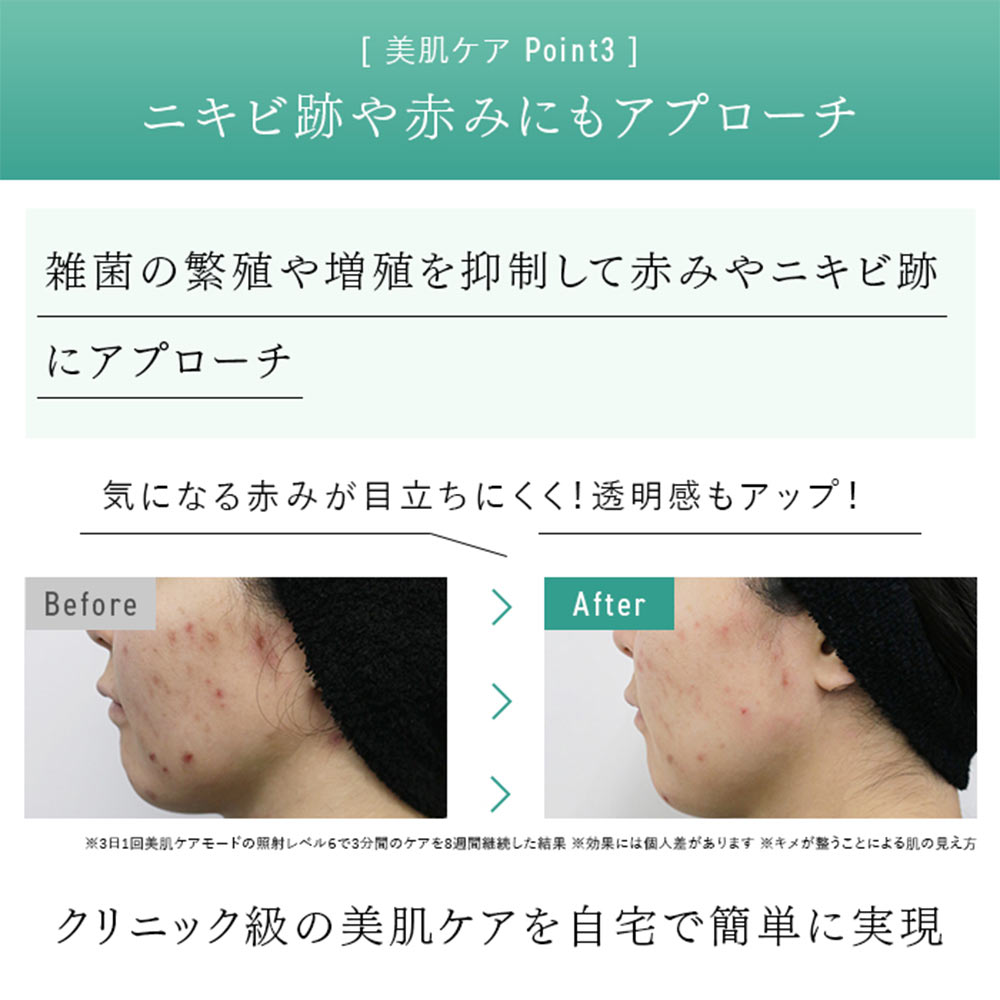 STELLA BEAUTE IPL&amp;LED光美容器 SB-IFD03 / STELLA BEAUTE（ステラ ボーテ） / その他美容家電 / STB10001_dt_08.jpg